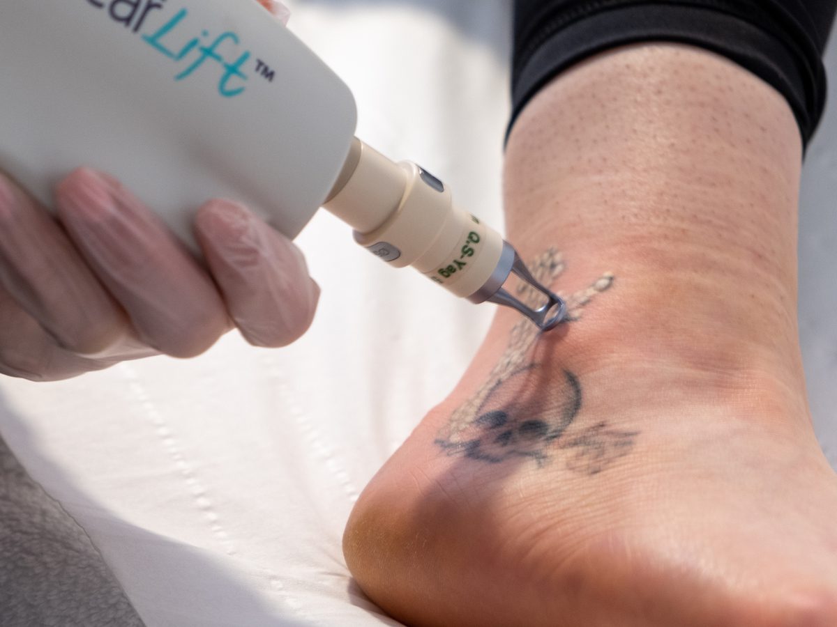 Understanding Laser Tattoo Removal - Skin Survival Laser Clinic Liverpool